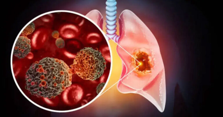 Lung Cancer Detection mein Badi Breakthrough: UK Scientists ka Naya Blood Test